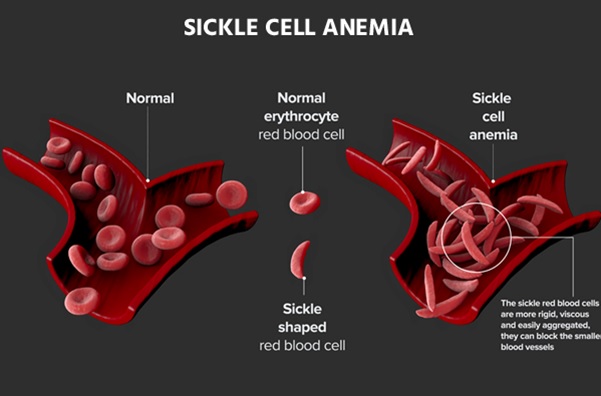 National Mission To Eradicate Sickle Cell Anemia Sanskriti IAS